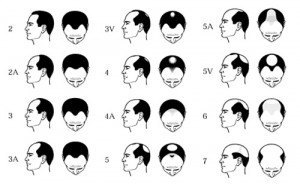 Norwood Scale for Male Pattern Hair Loss