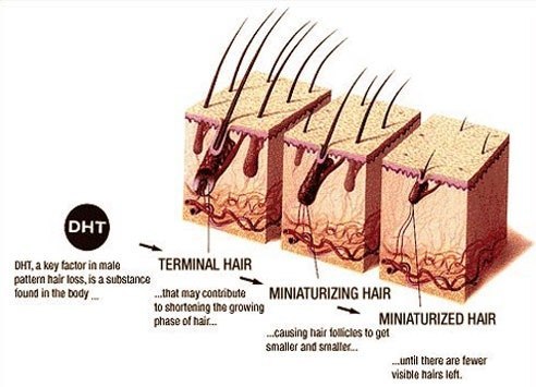 DHT Hair Follicle Miniaturization Process - Saw Palmetto for Hair Loss