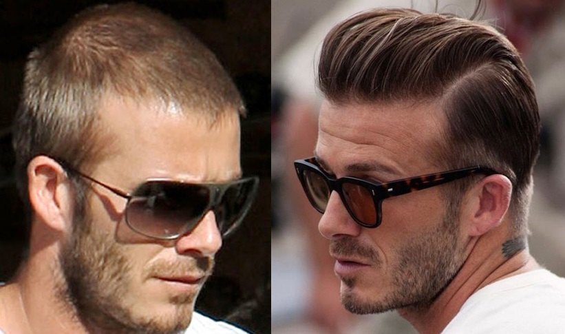 David Beckham Hair Transplant