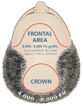 Hair Transplant Areas