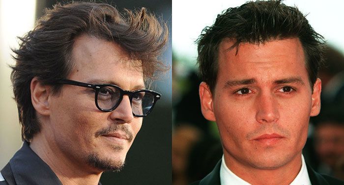 Johnny Depp Hair Transplant