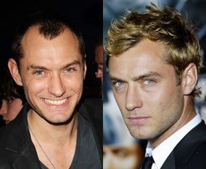 Jude Law Hair Transplant