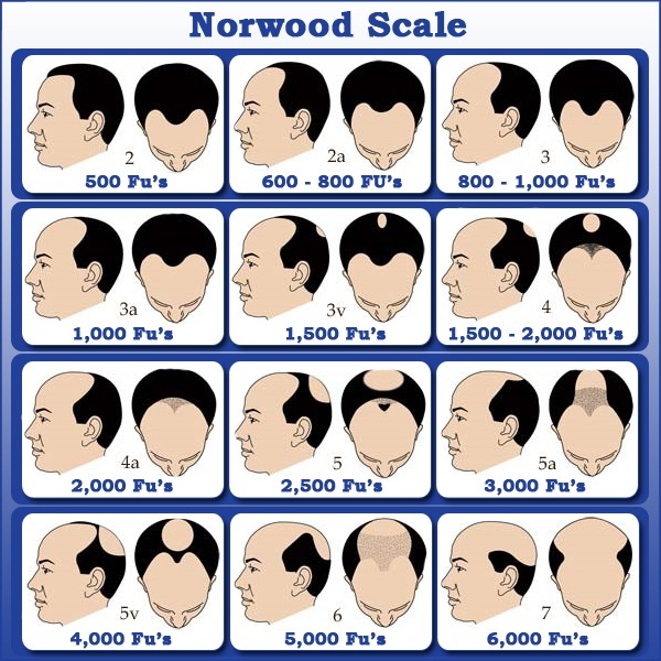 Norwood Scale Hair Transplant Requirement