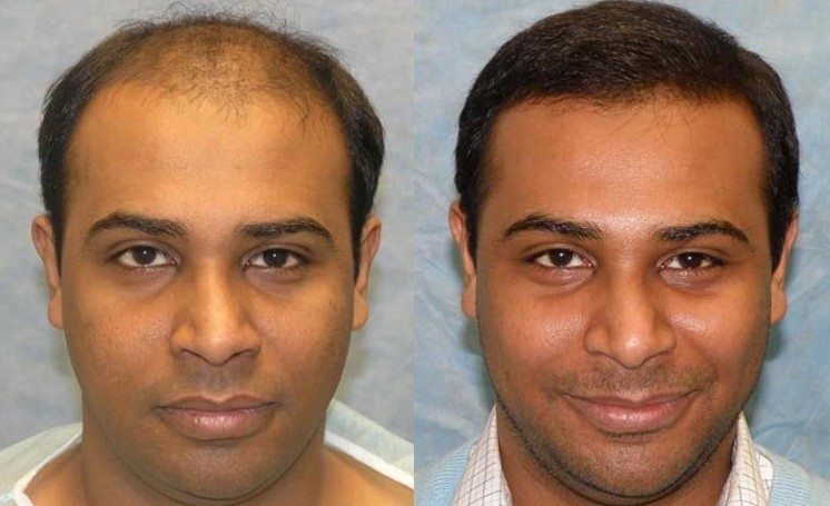 Successful Hair Transplant Surgery | Hold the Hairline
