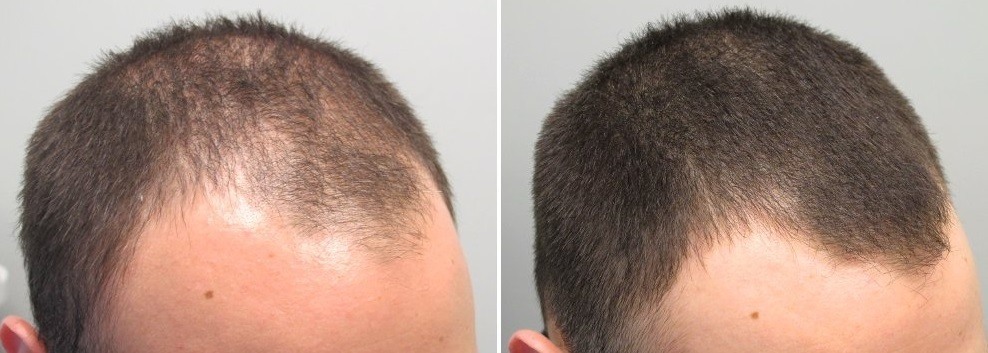 does rogaine work after hair transplant