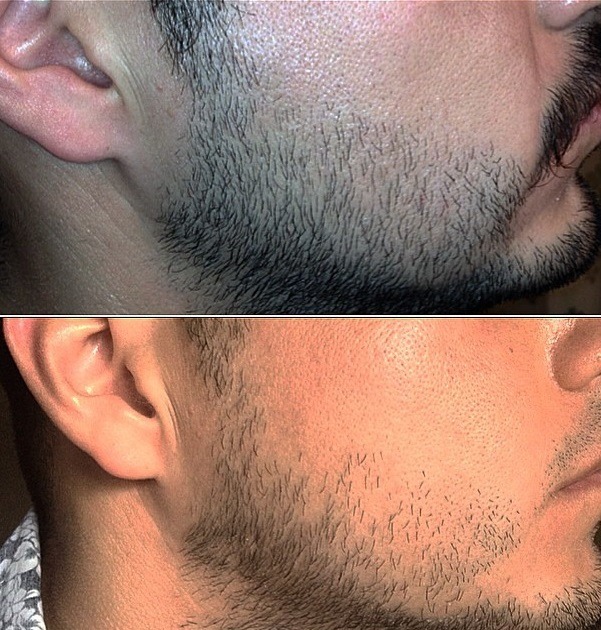Facial Hair Before and After