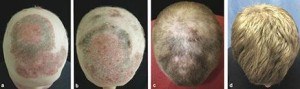 Tofacitnib Results - Hair Loss Cure