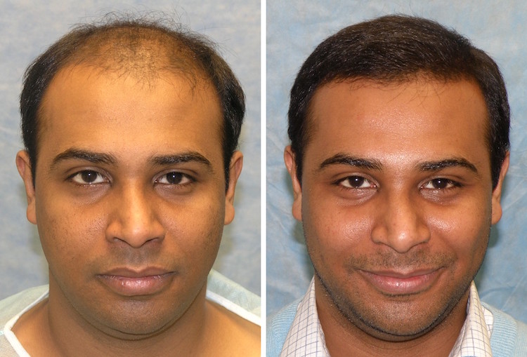 Before and After Hair Transplant Surgery
