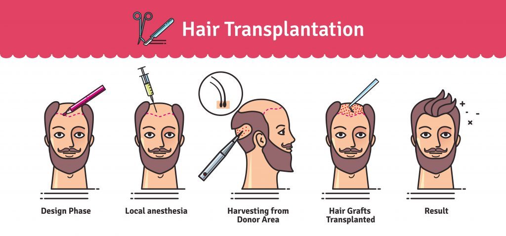 Best Hair Loss Concealers | Hair transplantation chart