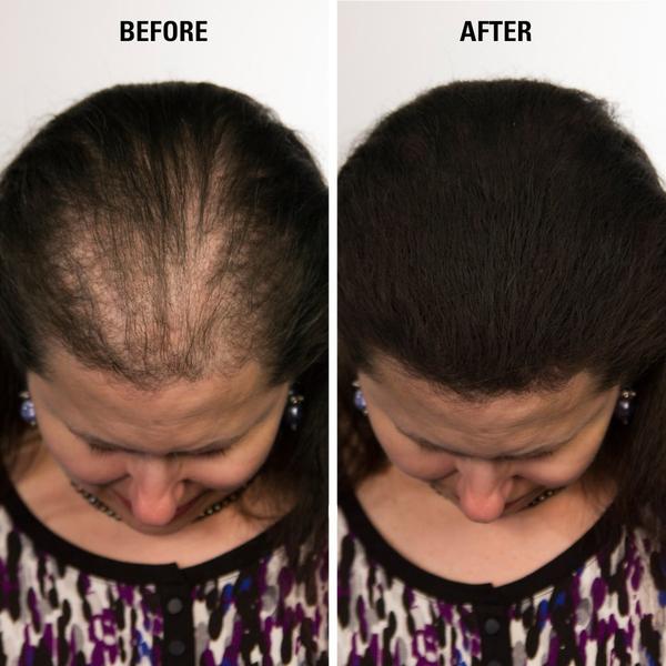 Best Hair Loss Concealers | Infinity before and after examples