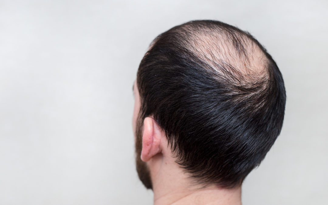 How to Prevent Hair Loss in Men: The Ultimate Guide