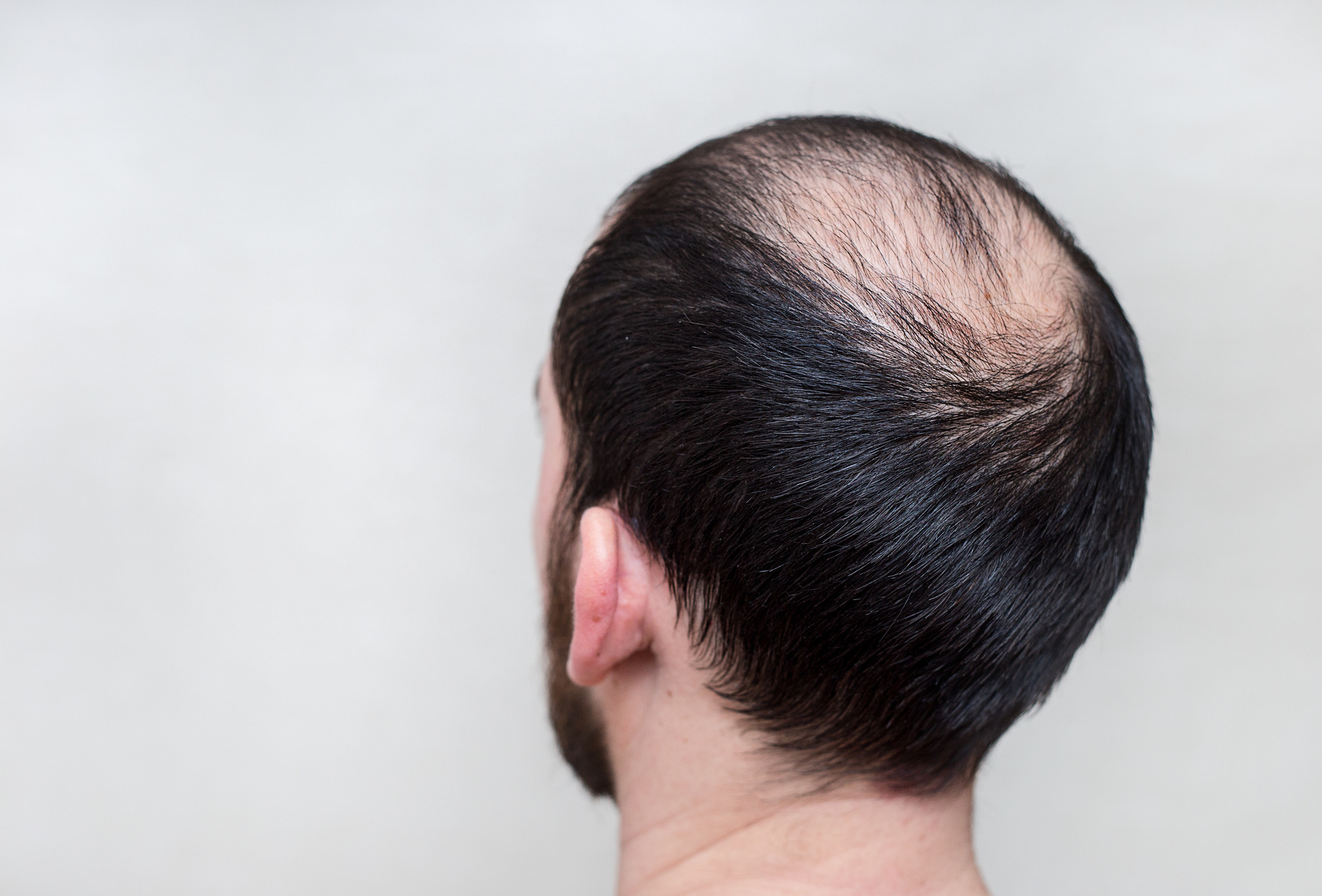 How to Prevent Hair Loss in Men: The Ultimate Guide | Hold ...
